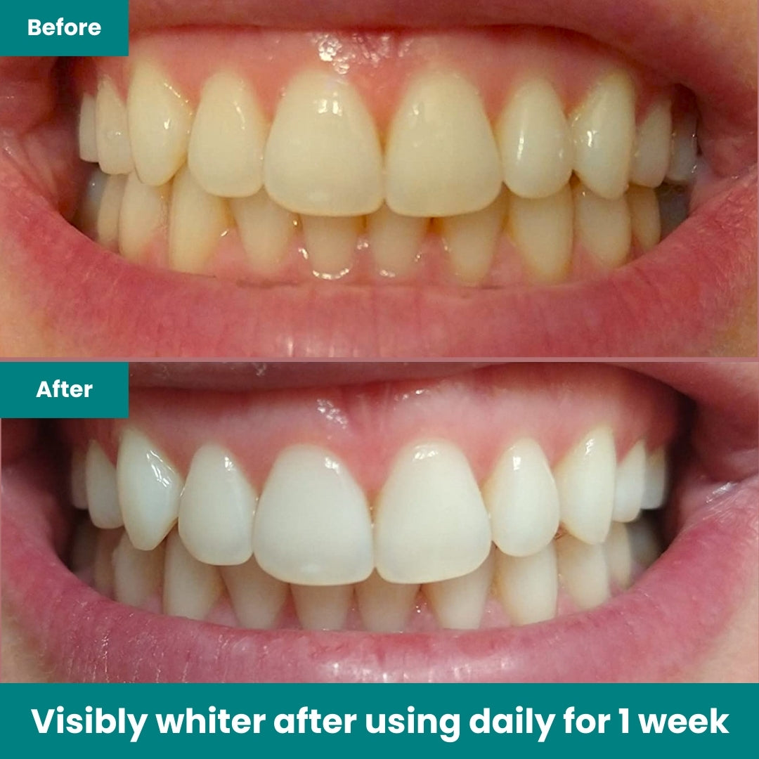 BlingSmile Whitening Duo